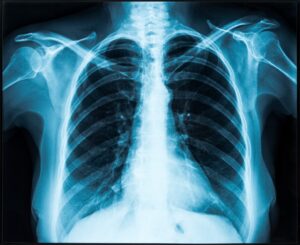 misdiagnosis of lung cancer