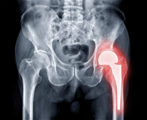 An x-ray with the damaged join highlighted in red after a botched hip surgery