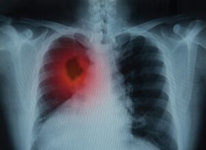 X-ray image of a red area of concern on a patient's lungs.