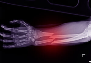 An x-ray shows a clearly broken forearm.