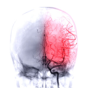 A graphic partially highlights a section of a person's brain in red